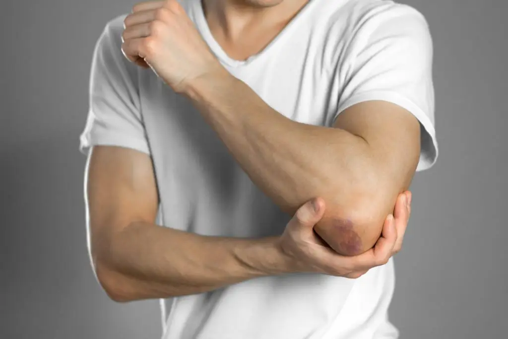 Douleur Contusion